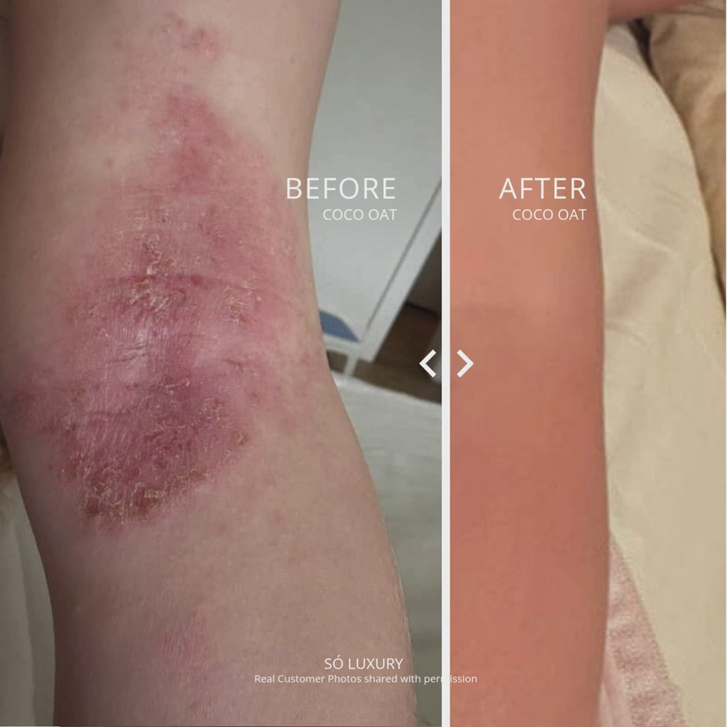 Before and After photos showing a severe rash before and clear skin after labelled with Before Coco Oat and After Coco Oat including a notation that Real Customer Photos shared with permission