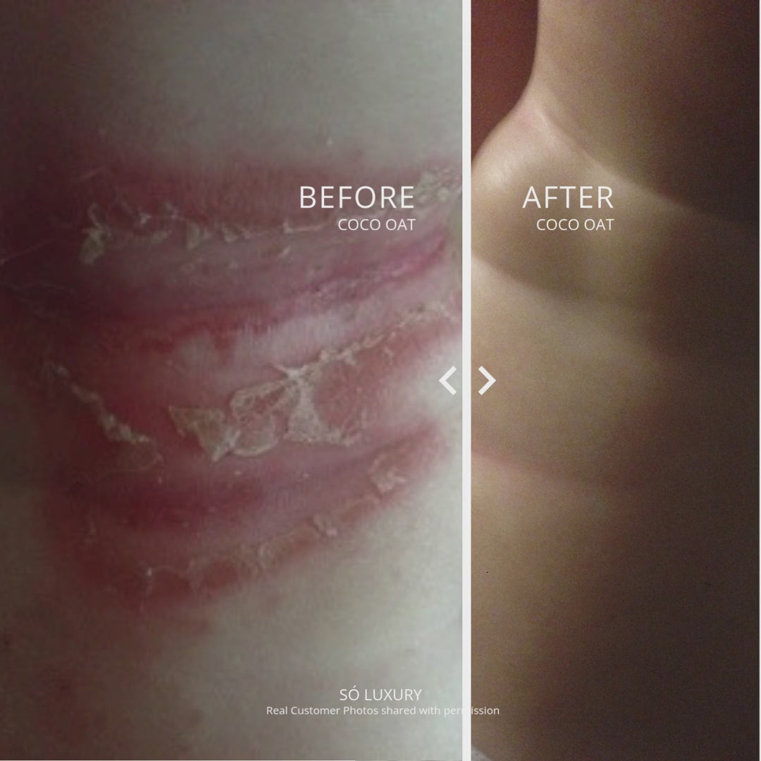 Before and After photos showing a severe rash before and clear skin after labelled with Before Coco Oat and After Coco Oat including a notation that Real Customer Photos shared with permission